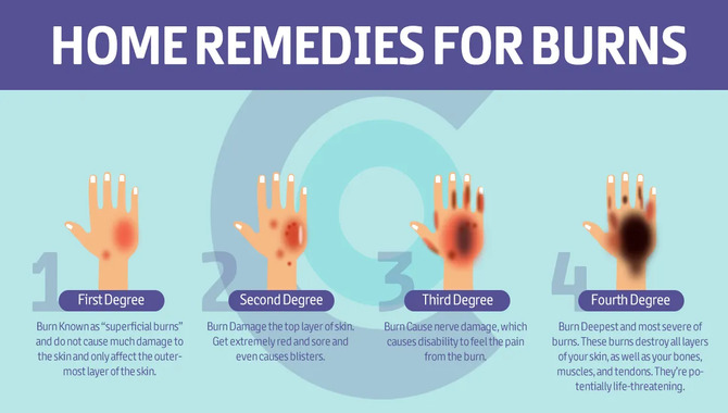 Home Remedies For Burns