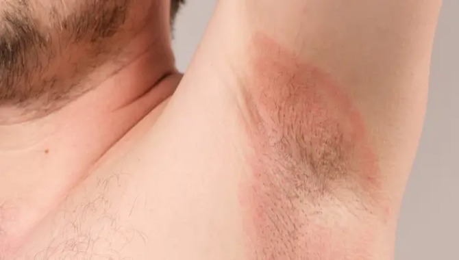 Itching Or Rash Around The Armpit