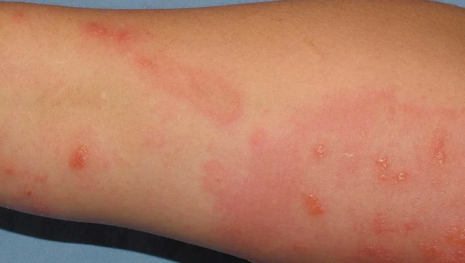 Persistent Itching Or Rash