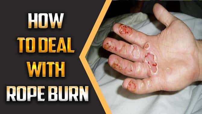 How To Deal With Rope Burn